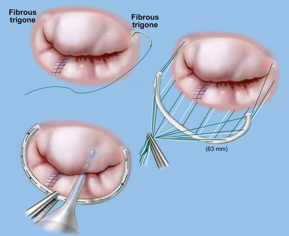 25 Elegant Heart Valve Surgery Risks