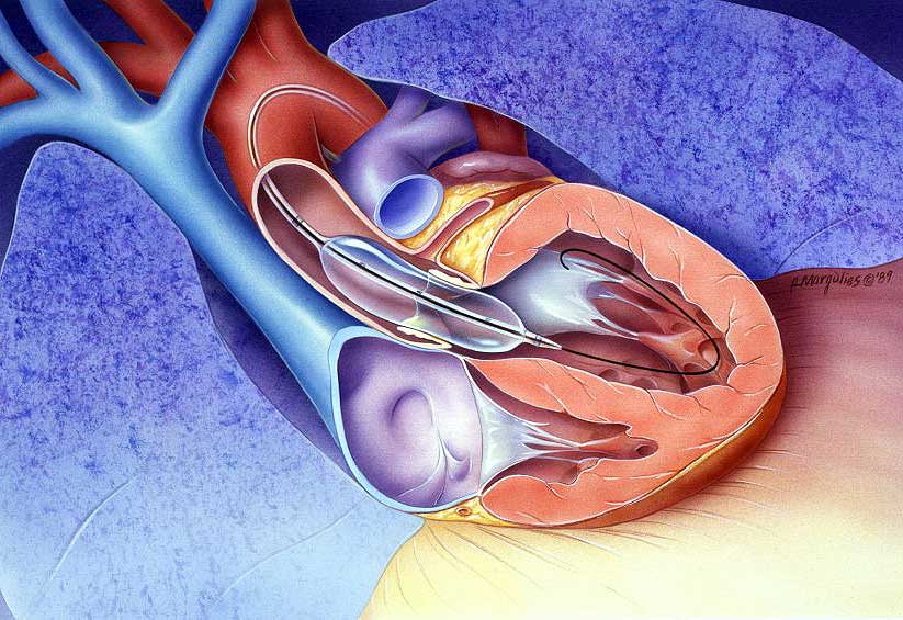 Mitral valve stenosis-Causes-Symptoms-Diagnosis-Dr Qaisar Ahmed-Pakistan's best Homeopathic doctor-Al Haytham clinic-Risalpur-KPK
