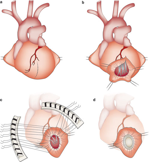 Ventricular-Remodeling-surgery